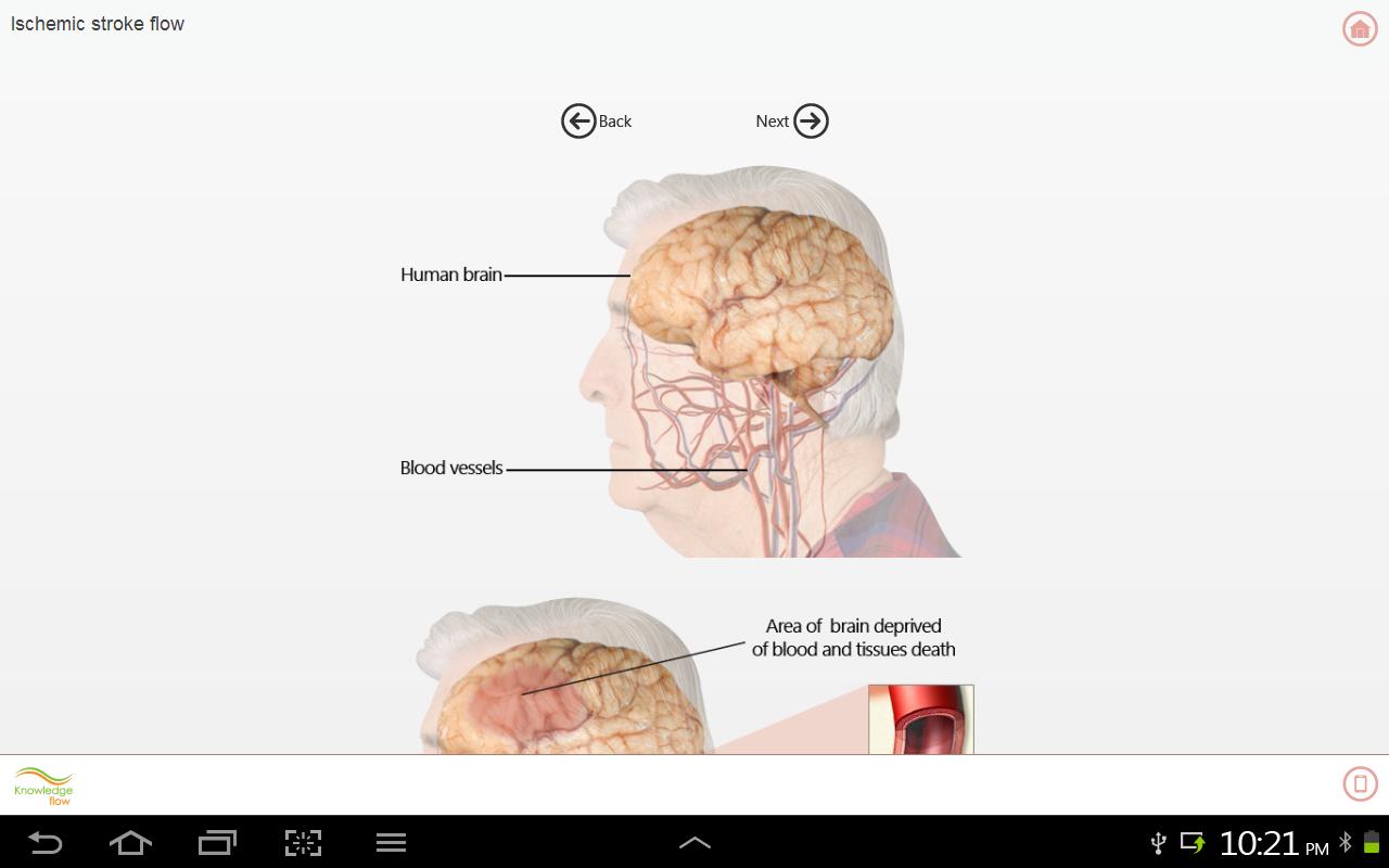 Brain Stroke