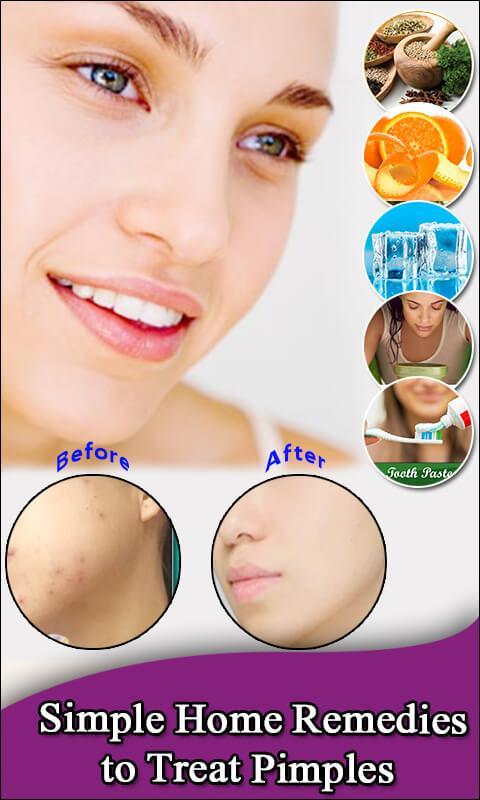 Pimple Remove in 7 Days
